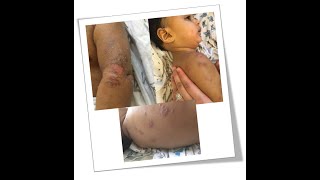 How I cured my Baby's Eczema. Baby Eczema Treatment & Cure.