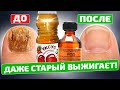 Помог рецепт из старой газеты, а не аптекарь! Грибок ногтей (йод, яблочный уксус)