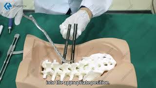 5 5 MIS Posterior Lumbar Screw System | Minimally Invasive Spinal Fixation – Surgical Technique screenshot 1