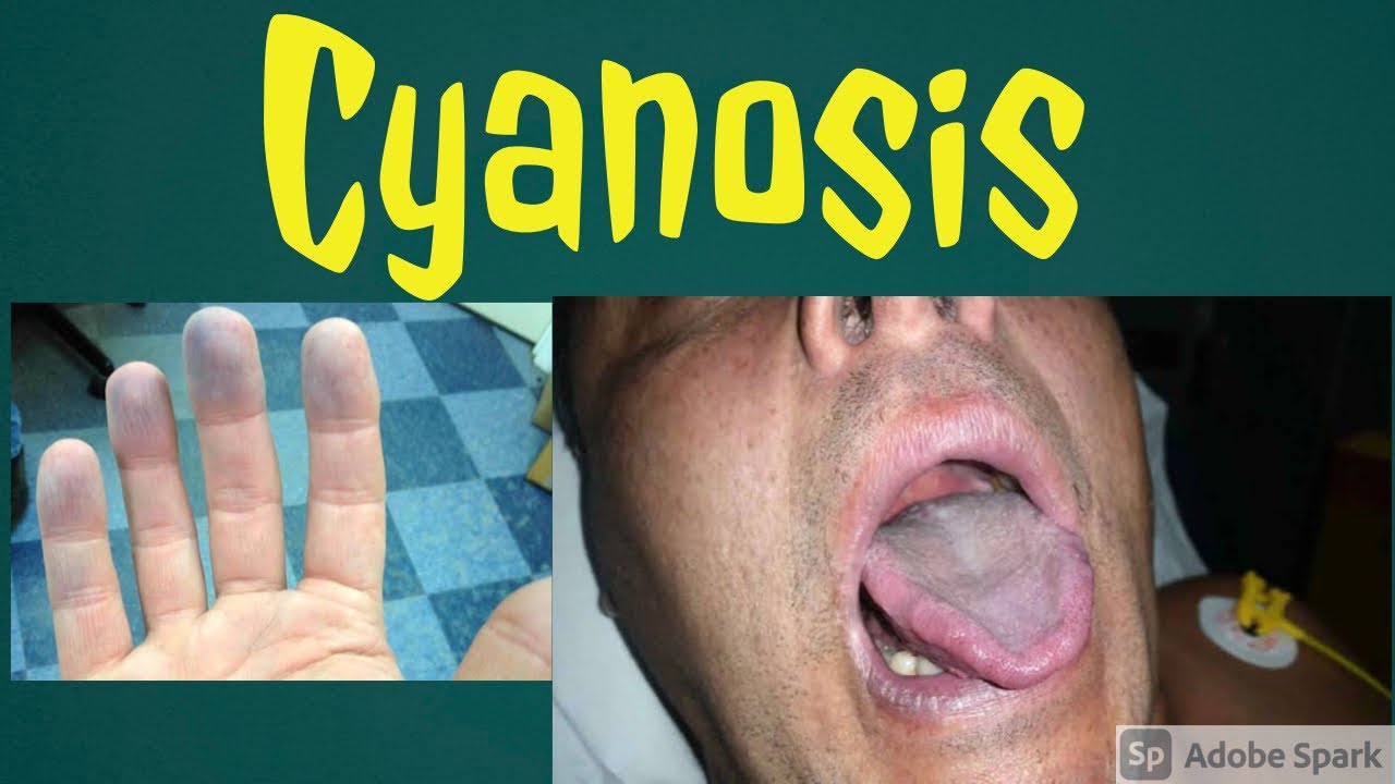 what is cyanosis in hindi