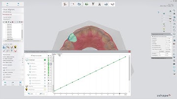 3Shape Clear Aligner Studio - Asistencia de setup y secuenciamiento - Way-Points - Setup and Staging
