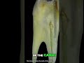 How to manage a ledge. #endodontics #ledge #rootcanal #dentistry #dentist