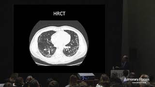 MDD and an Accurate Diagnosis in ILD | David Lederer, MD