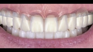 How to Design a Ivotion denture in Exocad