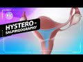 Diagnosing blocked fallopian tubes (3D Animation)