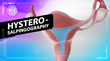 Diagnose van verstopte eileiders (3D-animatie)