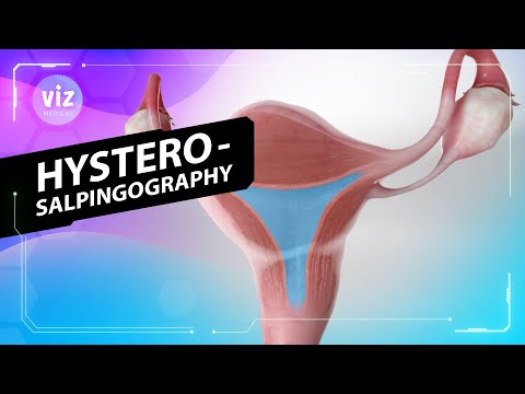 Diagnosing blocked fallopian tubes (3D Animation) - video from ViewMedica
