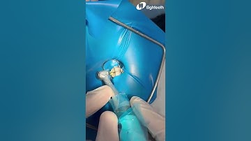 Root Canal Preparation Using Eighteeth E-FLEX BLUE Endo Files- Dr. Moh