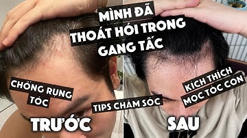 Bí kíp để tránh rụng tóc và kích thích mọc tóc của mình. Thoát hói tuổi 30// Dinology