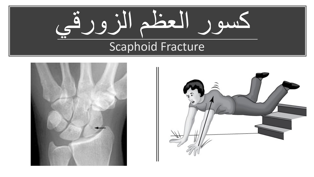 Scaphoid Fracture / كسر العظم الزورقي