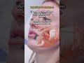 Nasolabial fold treatment tips