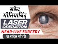 Cataract treatment with laser near live laser cataract surgery  no blade no pain no injection