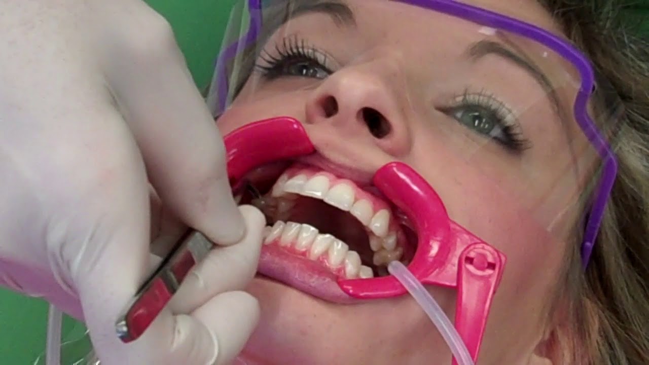 Getting Braces | Band and Bond | Putting Braces On | Adams Orthodontics Braces