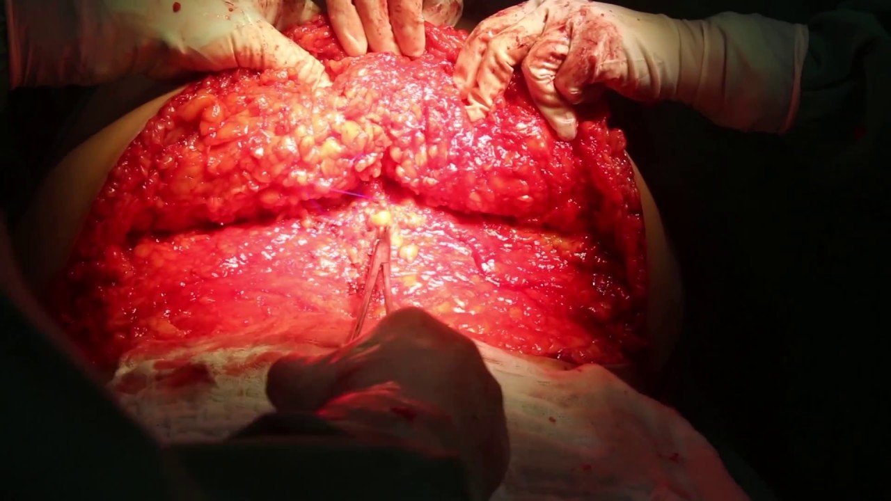 Diastase e hérnia umbilical / Diastase and umbilical hernia doutor estranho filme