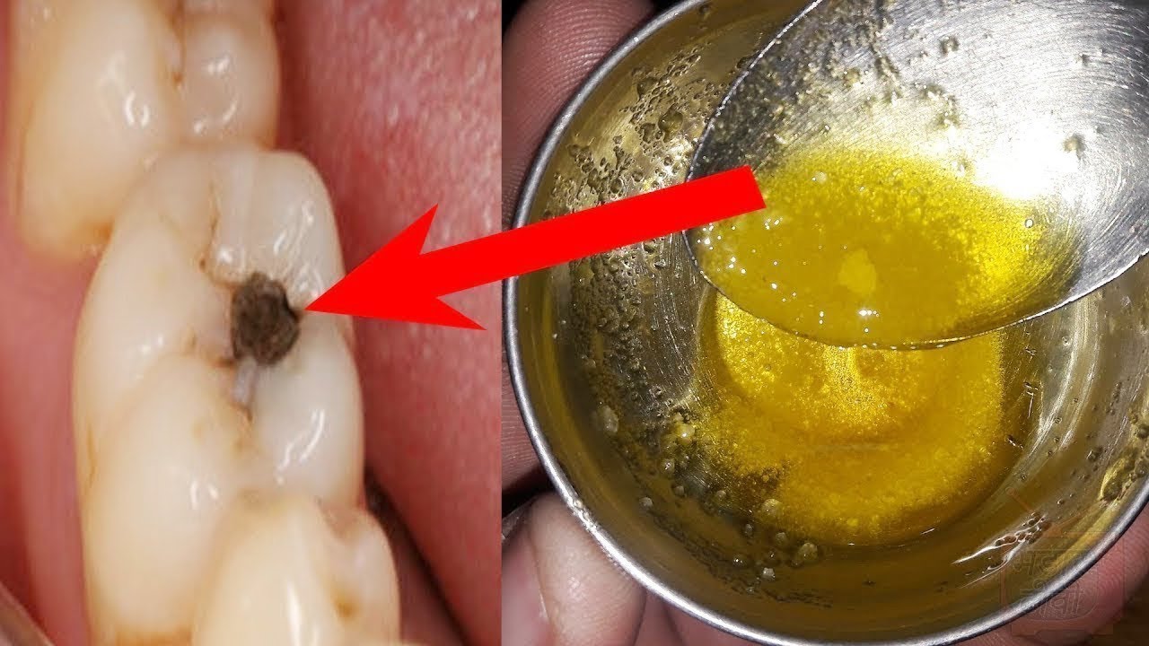 How to clear teeth cavities and whiten teeth in telugu Home remedies