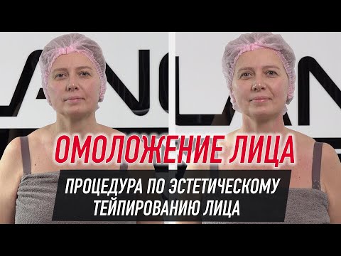 ✅ ОМОЛОЖЕНИЕ ЛИЦА.  ПРОЦЕДУРА ПО ЭСТЕТИЧЕСКОМУ ТЕЙПИРОВАНИЮ ЛИЦА | Валентин Гайт | BBALANCE