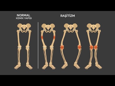 Raşitizm nedir? - Prof. Dr. Hakan Özsoy (Ortopedi ve Travmatoloji Uz.)