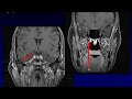 Imaging of the Nasopharynx