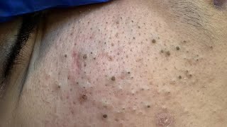Skincare | Best Pimple Treatment | Satisfying Blackheads And Whiteheads Removal Routine