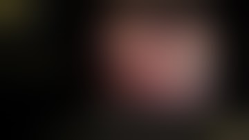 Laparoscopic subtotal gastrectomy with D2 lymph node dissection for gastric cancer - Step by step