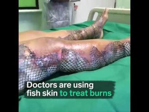 Burn treatment with the skin of Tilapia fish 