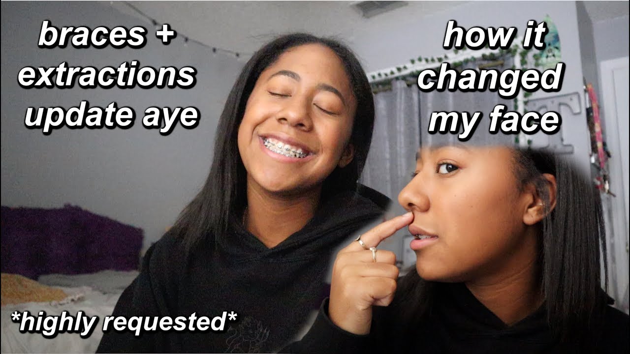 Braces Extractions Update How It S Changed My Face And More Youtube