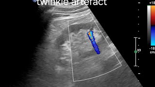 Identifying Renal Stones with Twinkle Artefact: A Key Ultrasound and Color Doppler Feature