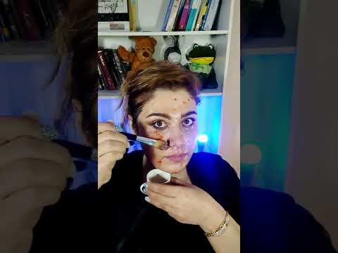 ازبین بردن جوش ها