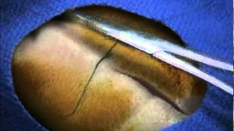 VIPER: Wound Closure #5: Simple Interrupted Sutures