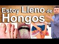 Estoy Lleno De Hongos - EN VIVO - Porque Estoy Lleno De Hongos Y Como Eliminarlos