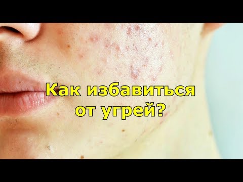 Вопрос: Как избавиться от угрей?