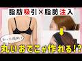 背中で取った脂肪を、おでこへ。｜脂肪吸引×脂肪注入の症例