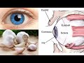 How To Use Pressed Garlic To Reverse Eyesight Loss Without Glasses Or Surgery | Life well lived