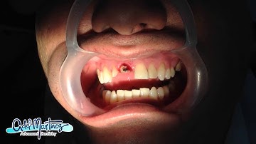 ANTERIOR SOCKET PRESERVATION