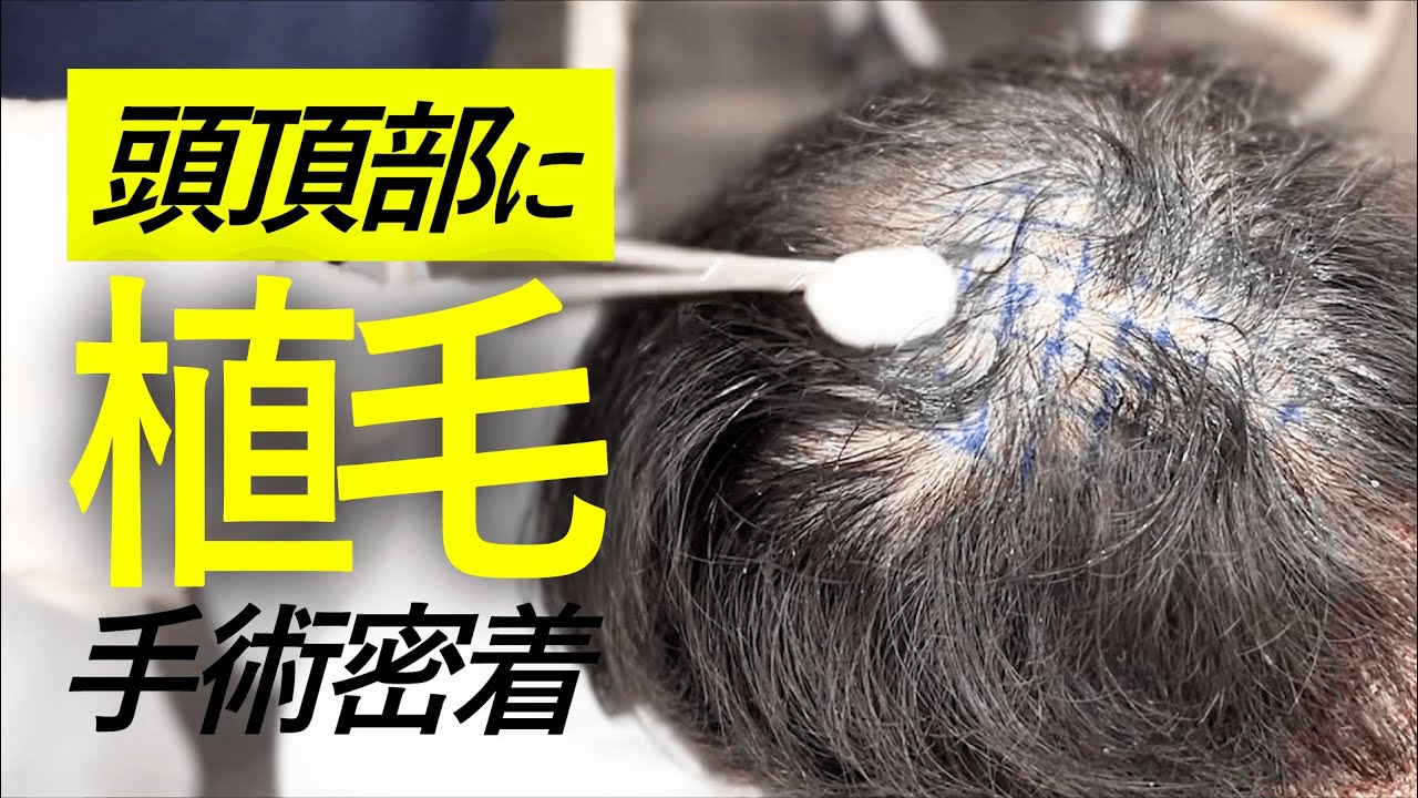 自毛植毛】頭頂部700グラフト-スマートFUE植毛【手術密着