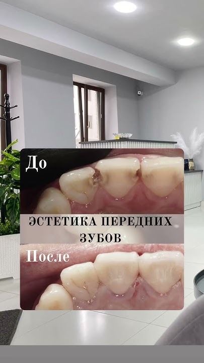Восстановление формы передних зубов - YouTube