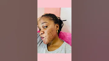 MATOKEO YA BIDHAA ZA MYFAIRSKIN MADOA NA CHUNUSI KUPUNGUA KWA KIASI KIKUBWA 