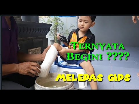 Video: Cara Mengambil Gips Kaki Dan Lengan Anak