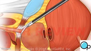 PreOp® Robotic Assisted Laparoscopic Radical Prostatectomy