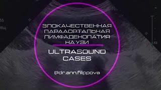 ПАРААОРТАЛЬНАЯ ЛИМФАДЕНОПАТИЯ на УЗИ 🦠 Ultrasound Cases🔎 PARAAORTAL LYMPHADENOPATHY on ultrasound 😷