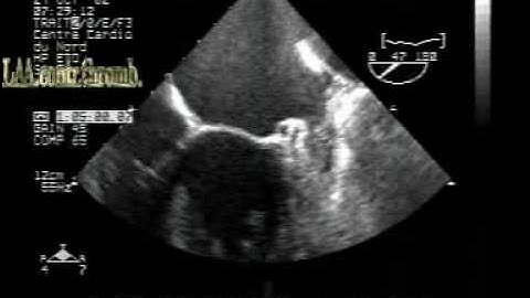 MS different aspects:left atrial appendage thrombus .TEE
