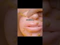 集合体恐怖症チェック ニキビ芯出し編 ASMR 