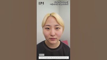 Combo nâng cơ mí mắt+mở góc mắt+nâng mũi+cấy, hút mỡ mặt tại DM #pttm #trendingshorts #nangmui