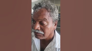 complete 3rd cranial nerve palsy#cranialnerve #ptosis#nervedamage