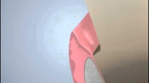 Tissue Tips Violation of Biological Width Video