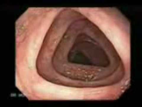 LIMPIEZA DE COLON CON MEDICINA NATURAL.wmv.flv