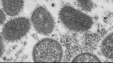 CDC: 2 children now have monkeypox