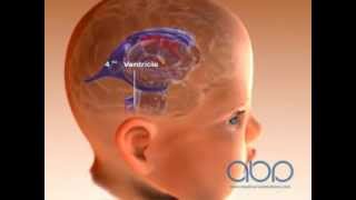 Brain Ventricle of a Baby screenshot 3