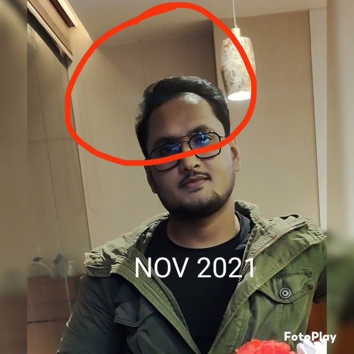 Download lagu 11 months hair transformation with traya's hair treatment