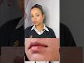 Treating Acne And Restoring The Skin Barrier 